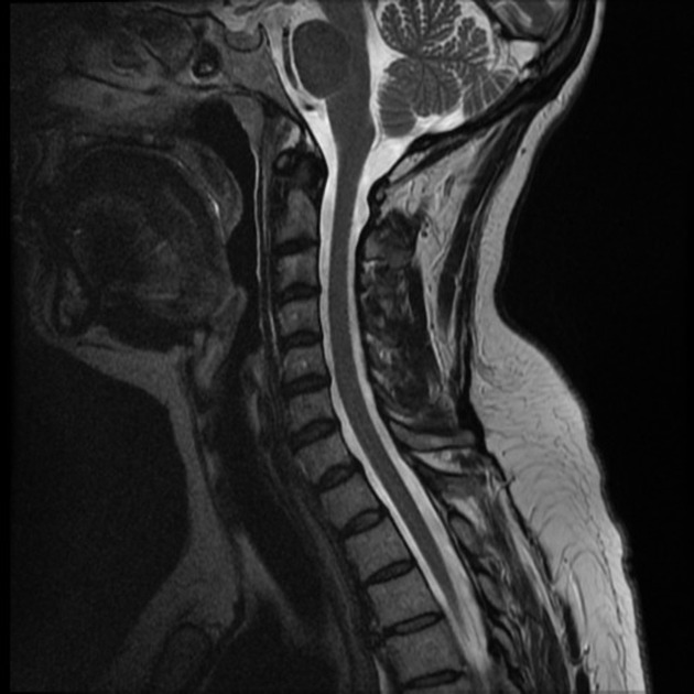 What to do with a normal MRI?