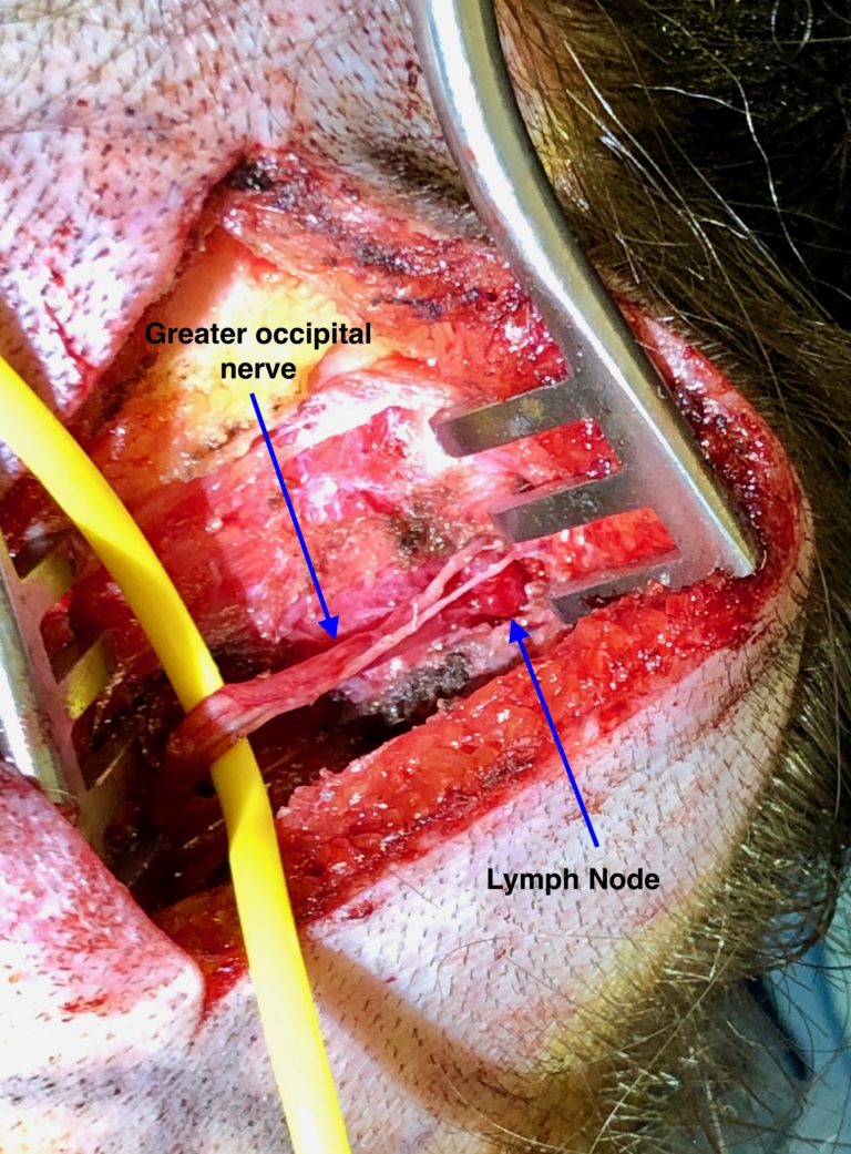 Occipital Nerve Decompression Photos | Migraine Surgery Specialty Center
